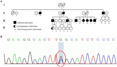 The Gly103Arg variant in hereditary transthyretin amyloidosis